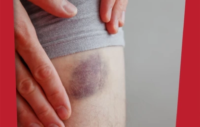 Zašto se stvaraju modrice