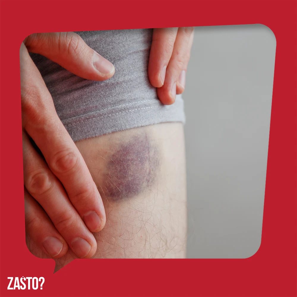 Zašto se stvaraju modrice