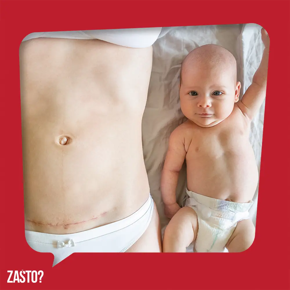 Zašto se zove carski rez - mama i beba