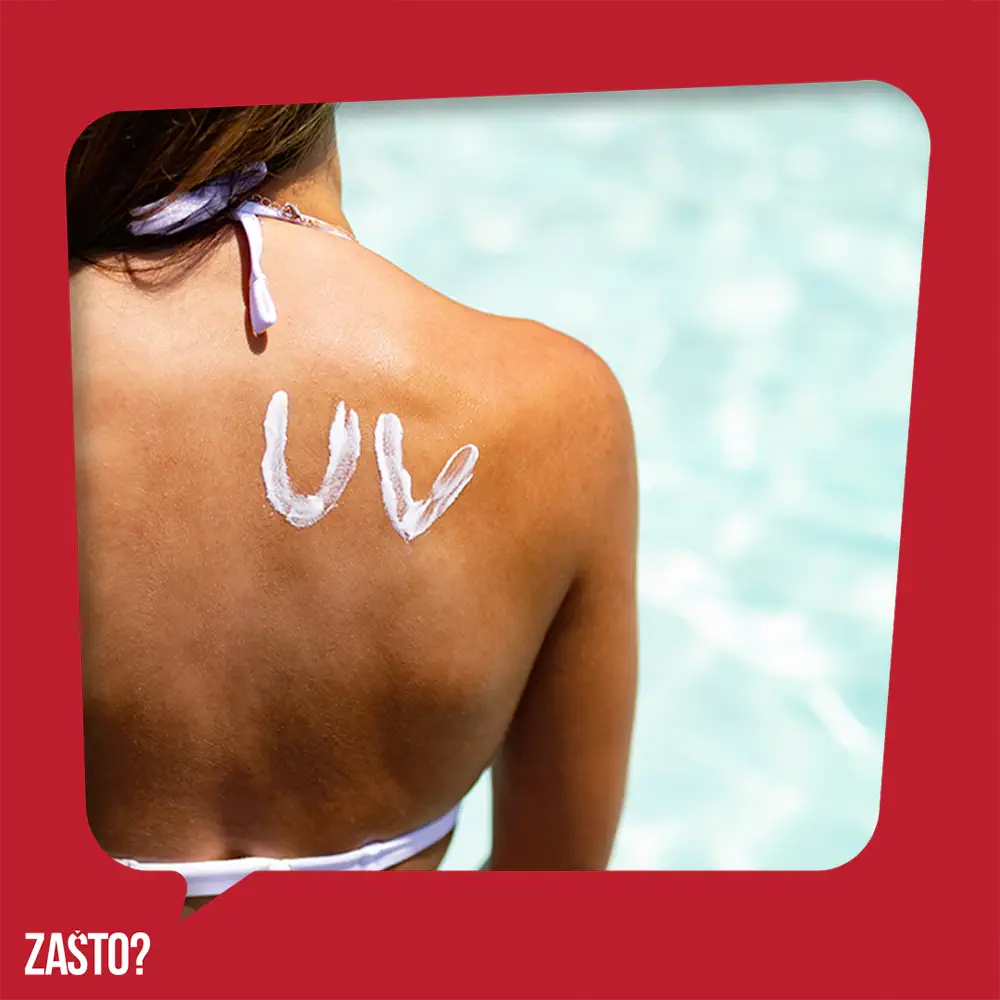 Zašto se koža ljušti posle sunčanja